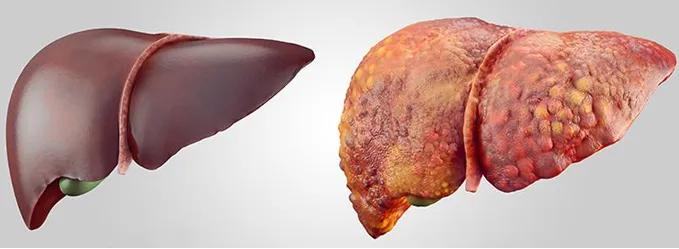 Hepatits B-Zirrhose